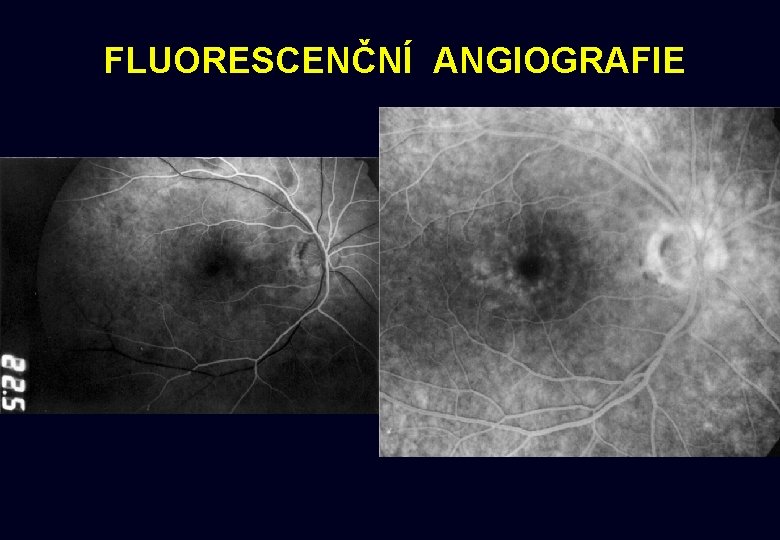 FLUORESCENČNÍ ANGIOGRAFIE 