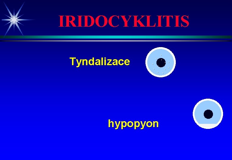 IRIDOCYKLITIS Tyndalizace . . . hypopyon 