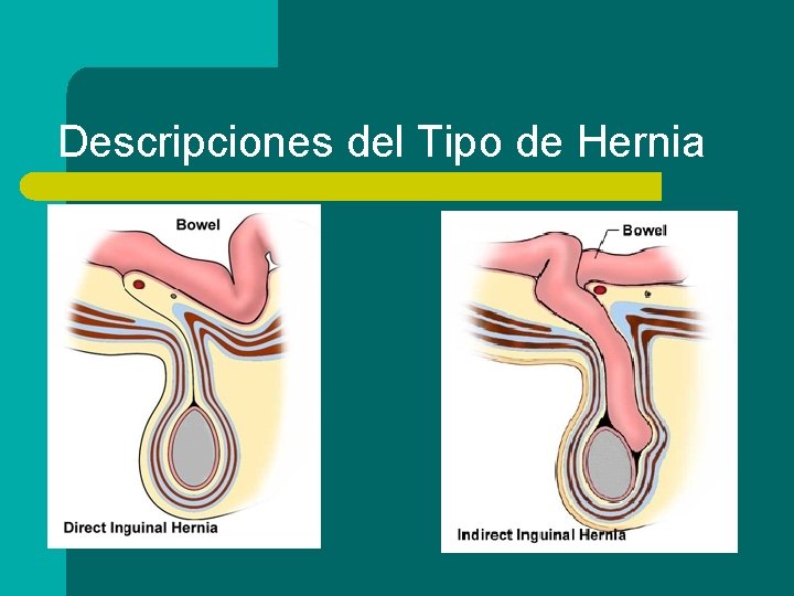 Descripciones del Tipo de Hernia Inguinal Directa Inguinal Indirecta 