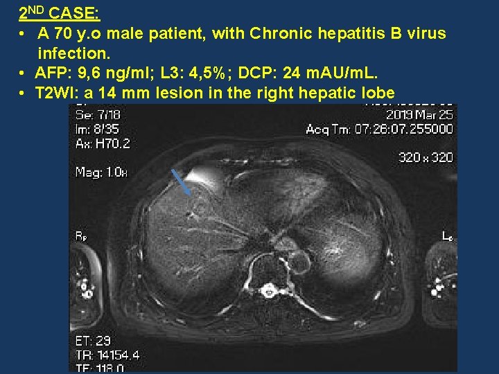 2 ND CASE: • A 70 y. o male patient, with Chronic hepatitis B