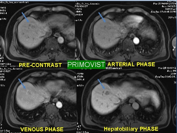 PRE-CONTRAST VENOUS PHASE PRIMOVIST ARTERIAL PHASE Hepatobiliary PHASE 