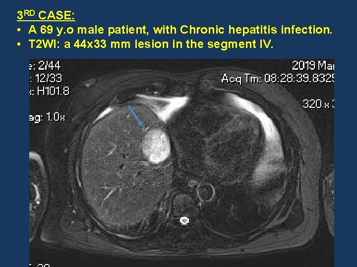 3 RD CASE: • A 69 y. o male patient, with Chronic hepatitis infection.