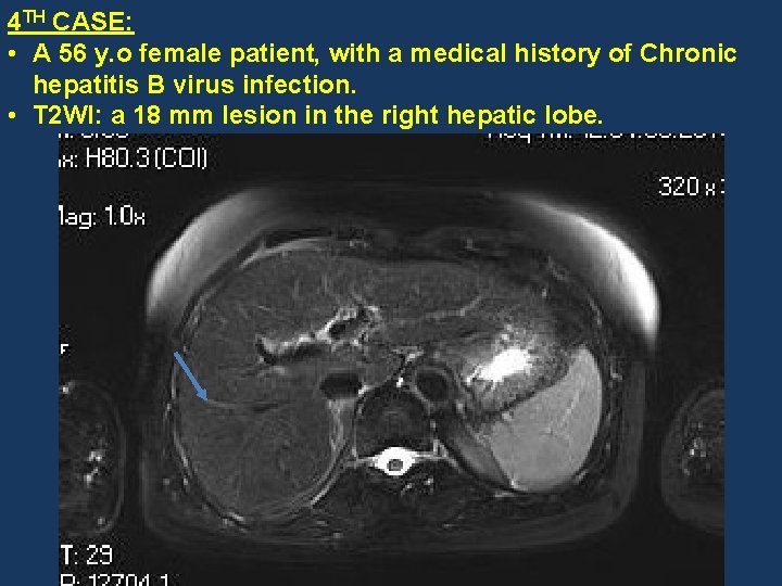 4 TH CASE: • A 56 y. o female patient, with a medical history