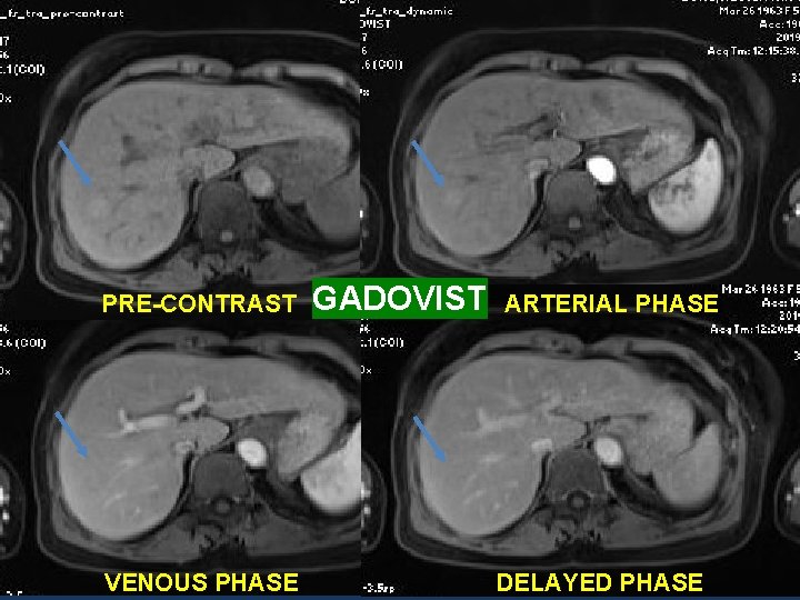 PRE-CONTRAST VENOUS PHASE GADOVIST ARTERIAL PHASE DELAYED PHASE 