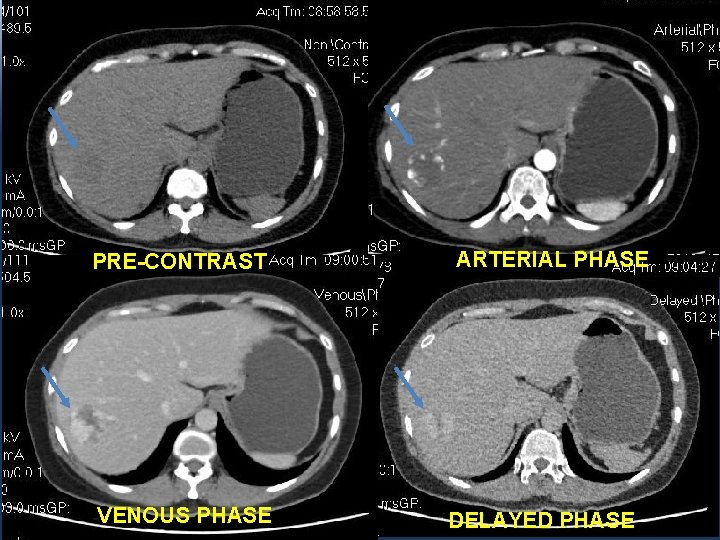 PRE-CONTRAST VENOUS PHASE ARTERIAL PHASE DELAYED PHASE 