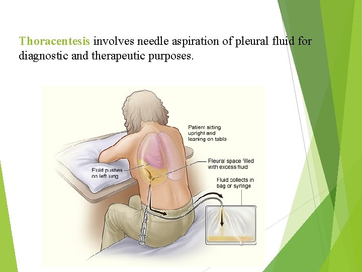 Thoracentesis involves needle aspiration of pleural fluid for diagnostic and therapeutic purposes. 
