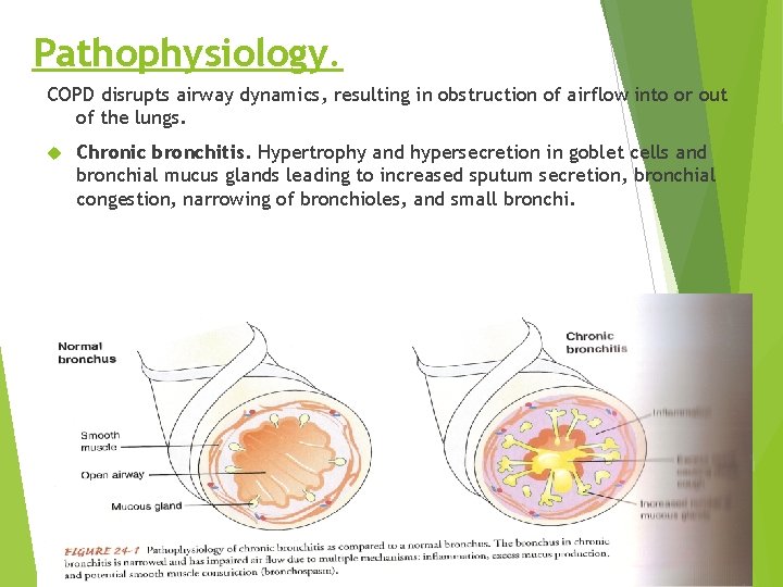 Pathophysiology. COPD disrupts airway dynamics, resulting in obstruction of airflow into or out of