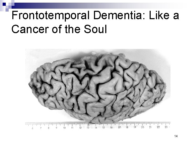 Frontotemporal Dementia: Like a Cancer of the Soul 14 