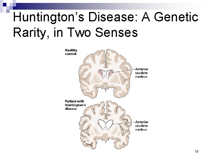 Huntington’s Disease: A Genetic Rarity, in Two Senses 18 