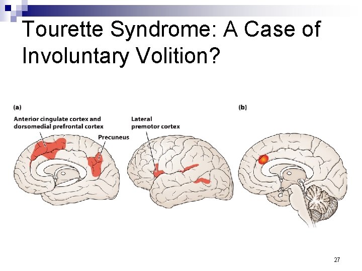 Tourette Syndrome: A Case of Involuntary Volition? 27 