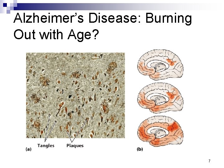 Alzheimer’s Disease: Burning Out with Age? 7 