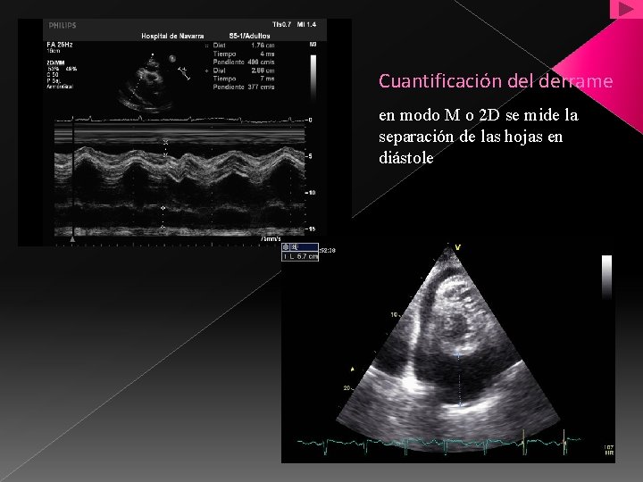 Cuantificación del derrame en modo M o 2 D se mide la separación de