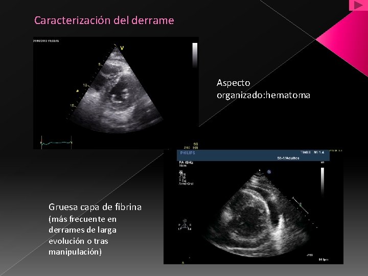 Caracterización del derrame Aspecto organizado: hematoma Gruesa capa de fibrina (más frecuente en derrames