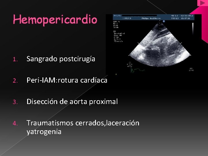 Hemopericardio 1. Sangrado postcirugía 2. Peri-IAM: rotura cardíaca 3. Disección de aorta proximal 4.