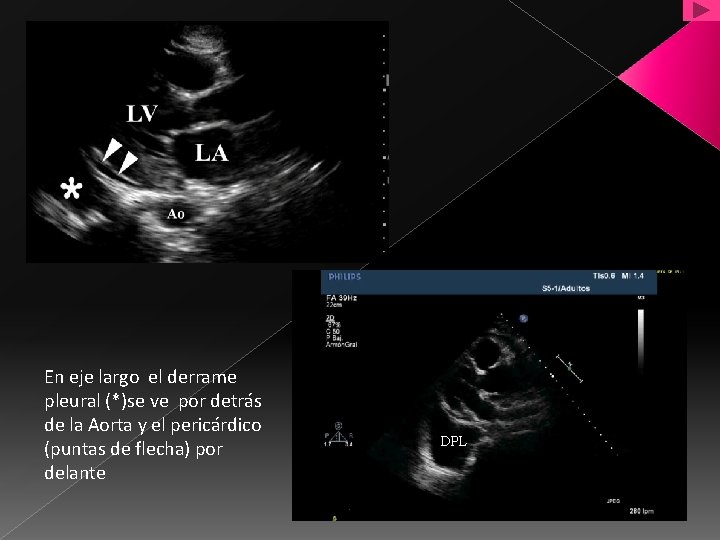 En eje largo el derrame pleural (*)se ve por detrás de la Aorta y