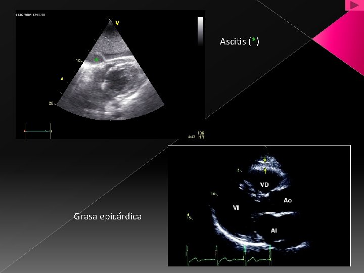 Ascitis (*) * Grasa epicárdica 