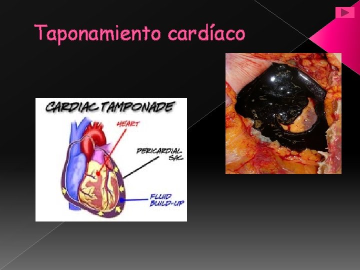 Taponamiento cardíaco 