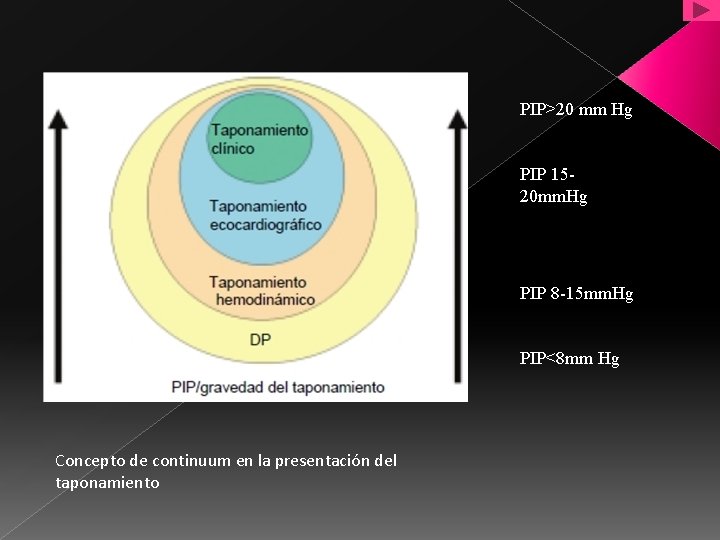 PIP>20 mm Hg PIP 1520 mm. Hg PIP 8 -15 mm. Hg PIP<8 mm