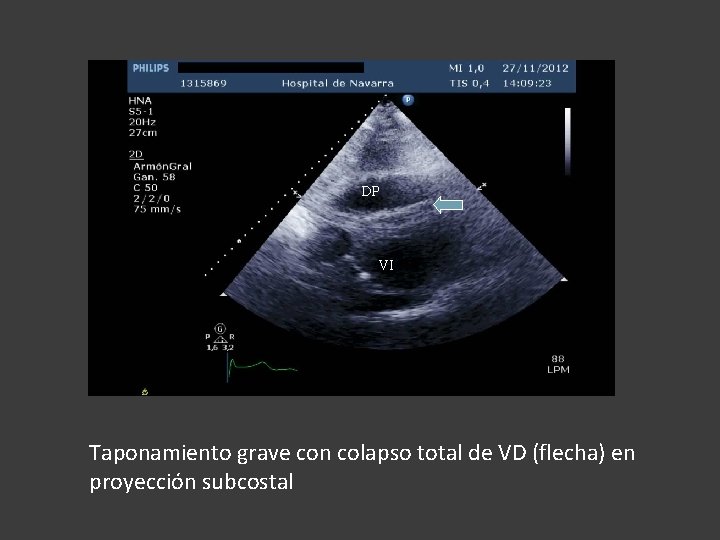 DP VI Taponamiento grave con colapso total de VD (flecha) en proyección subcostal 