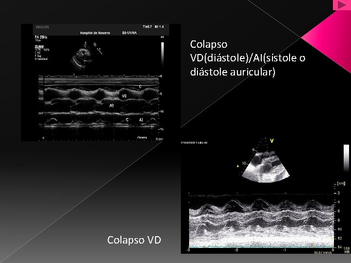 Colapso VD(diástole)/AI(sístole o diástole auricular) Colapso VD 