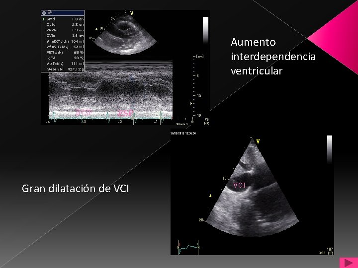 Aumento interdependencia ventricular INSP ESP Gran dilatación de VCI 