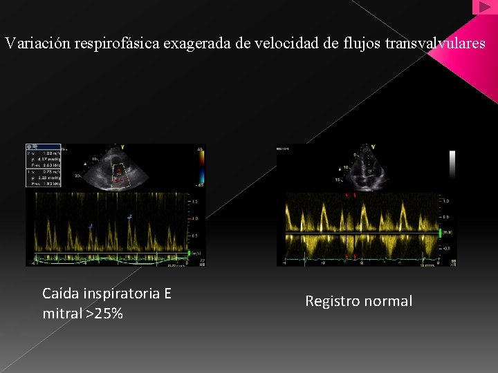 Variación respirofásica exagerada de velocidad de flujos transvalvulares Caída inspiratoria E mitral >25% Registro