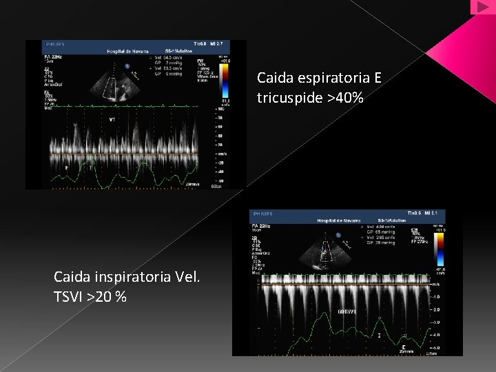 Caida espiratoria E tricuspide >40% Caida inspiratoria Vel. TSVI >20 % 