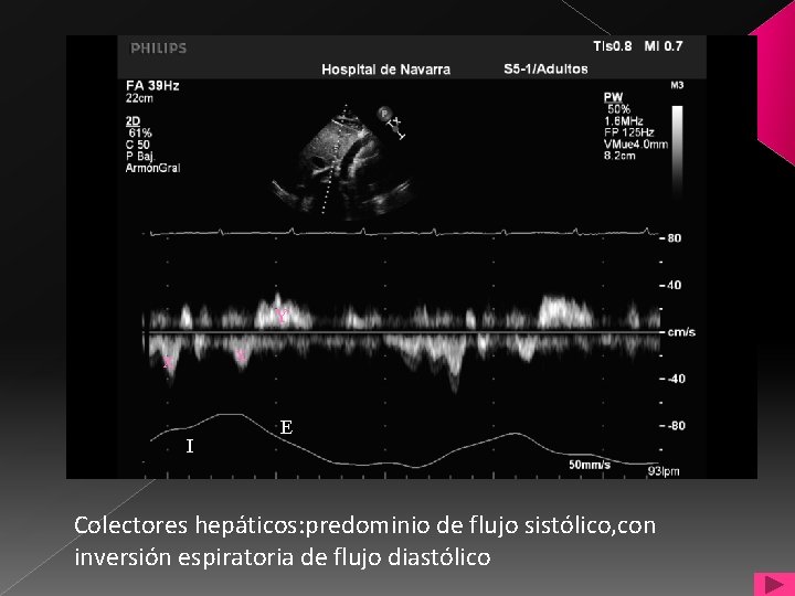 Y x x I E Colectores hepáticos: predominio de flujo sistólico, con inversión espiratoria