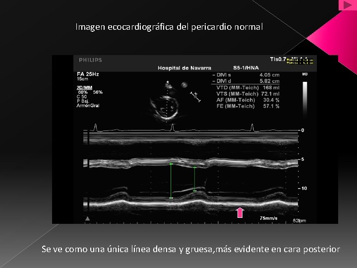 Imagen ecocardiográfica del pericardio normal Se ve como una única línea densa y gruesa,