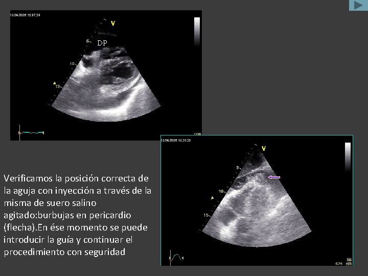 DP Verificamos la posición correcta de la aguja con inyección a través de la