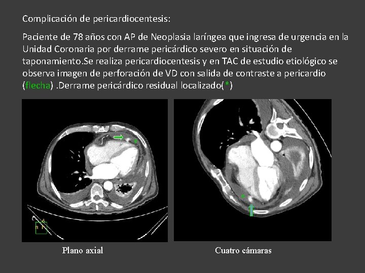 Complicación de pericardiocentesis: Paciente de 78 años con AP de Neoplasia laríngea que ingresa