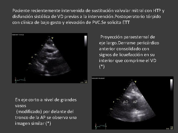 Paciente recientemente intervenida de sustitución valvular mitral con HTP y disfunción sistólica de VD