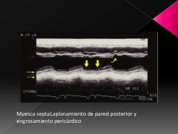 Muesca septal, aplanamiento de pared posterior y engrosamiento pericárdico 