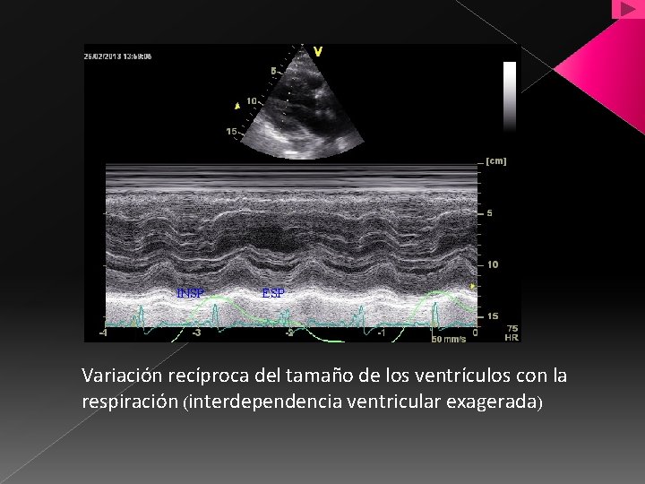 INSP ESP Variación recíproca del tamaño de los ventrículos con la respiración (interdependencia ventricular