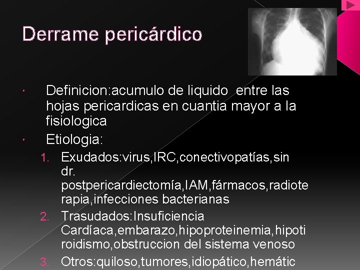 Derrame pericárdico Definicion: acumulo de liquido entre las hojas pericardicas en cuantia mayor a