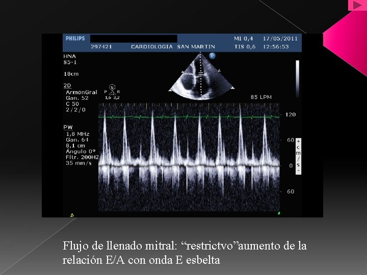 Flujo de llenado mitral: “restrictvo”aumento de la relación E/A con onda E esbelta 