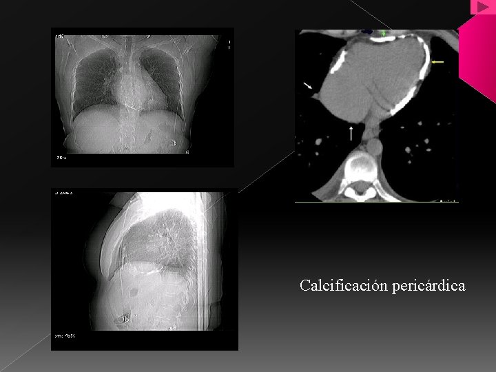 Calcificación pericárdica 