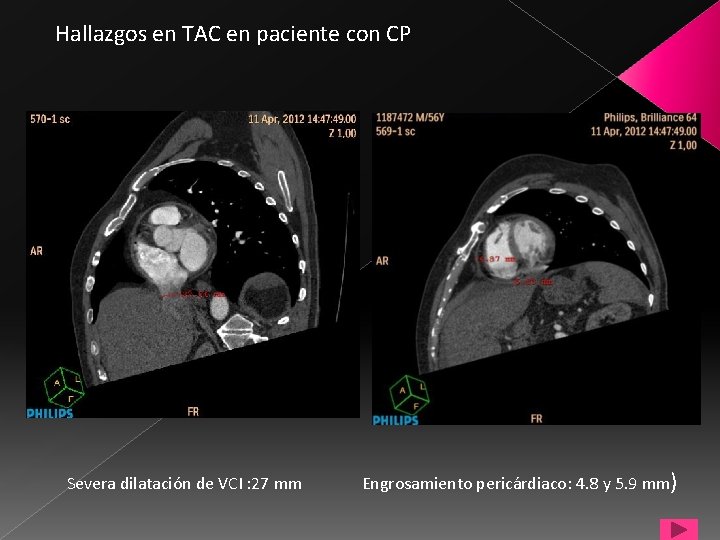 Hallazgos en TAC en paciente con CP Severa dilatación de VCI : 27 mm