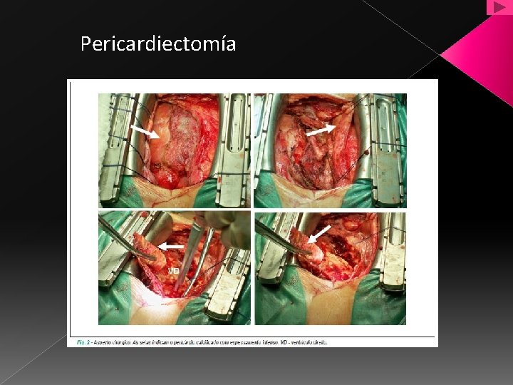 Pericardiectomía 