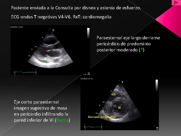 Paciente enviada a la Consulta por disnea y astenia de esfuerzo. ECG ondas T