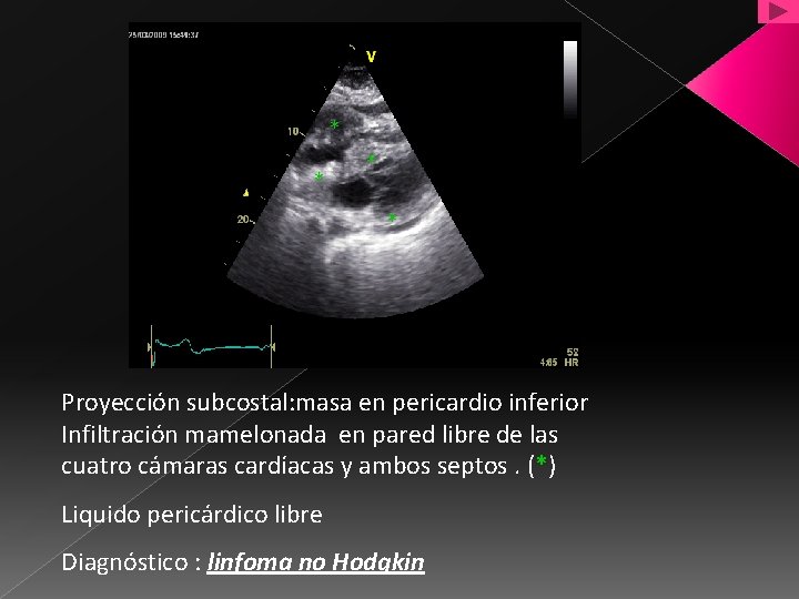 * * * * Proyección subcostal: masa en pericardio inferior Infiltración mamelonada en pared