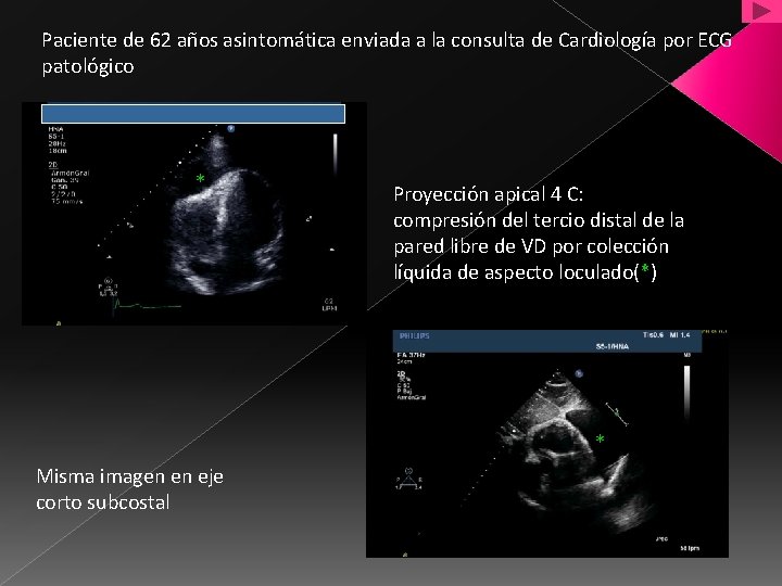 Paciente de 62 años asintomática enviada a la consulta de Cardiología por ECG patológico