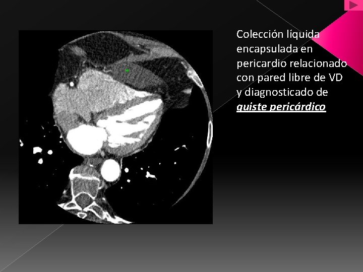 * Colección líquida encapsulada en pericardio relacionado con pared libre de VD y diagnosticado