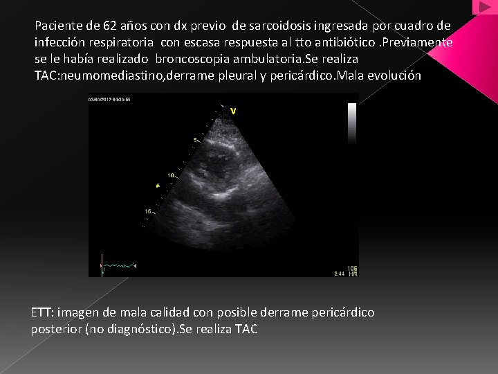 Paciente de 62 años con dx previo de sarcoidosis ingresada por cuadro de infección