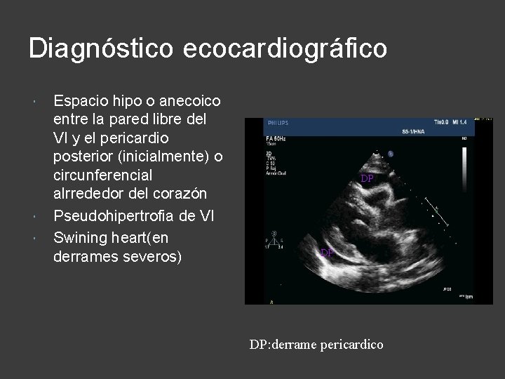 Diagnóstico ecocardiográfico Espacio hipo o anecoico entre la pared libre del VI y el