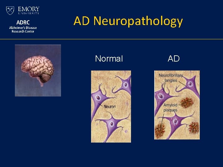 AD Neuropathology Normal AD AD Neuropathology Normal AD