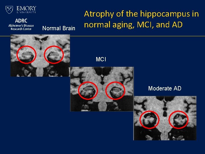 Normal Brain Atrophy of the hippocampus in normal aging, MCI, and AD MCI Normal Brain Atrophy of the hippocampus in normal aging, MCI, and AD MCI