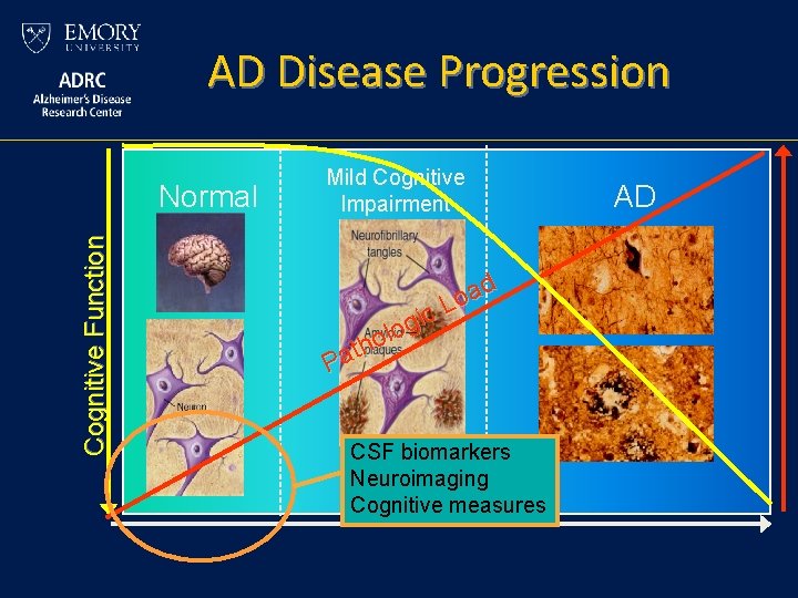 AD Disease Progression Cognitive Function Normal Mild Cognitive Impairment d a o L c AD Disease Progression Cognitive Function Normal Mild Cognitive Impairment d a o L c