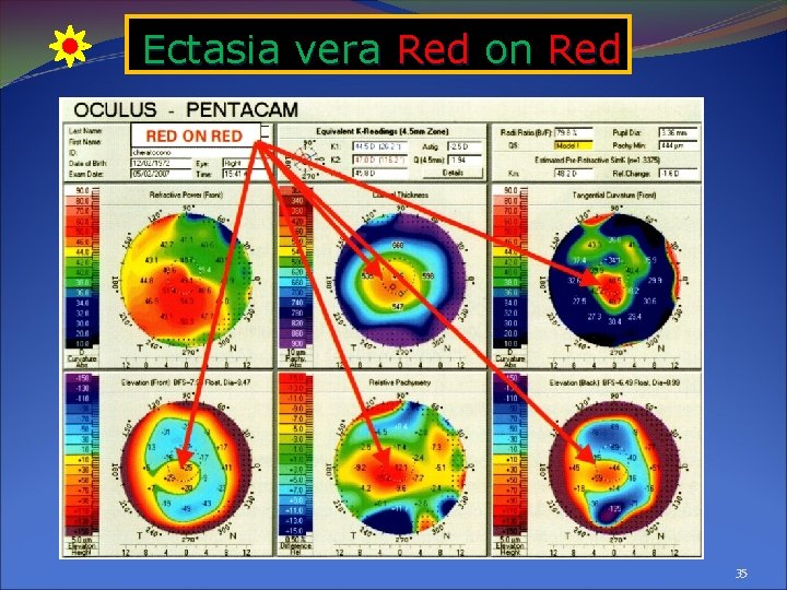 Ectasia vera Red on Red 35 Ectasia vera Red on Red 35