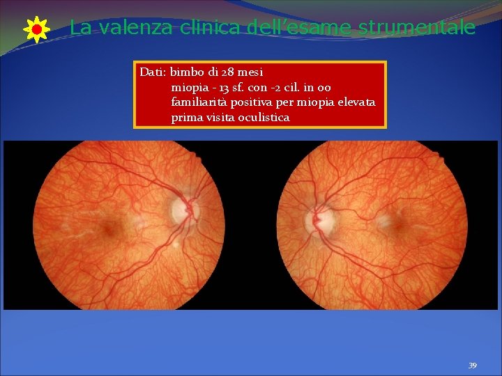 La valenza clinica dell’esame strumentale Dati: bimbo di 28 mesi miopia - 13 sf. La valenza clinica dell’esame strumentale Dati: bimbo di 28 mesi miopia - 13 sf.
